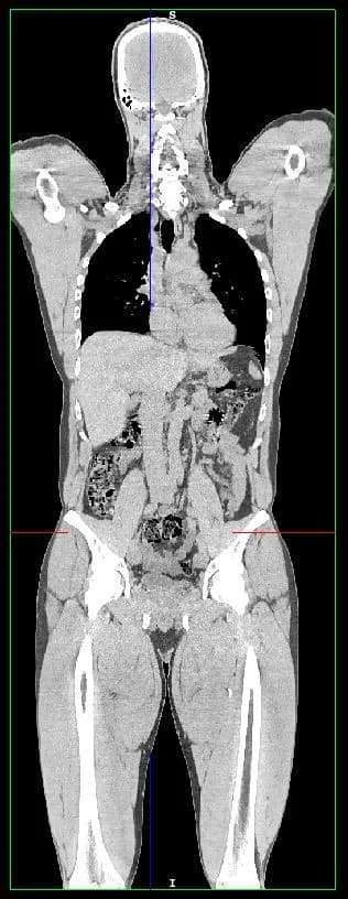 A coronal slice of the full-body exam, in greyscale, from the head to the thighs