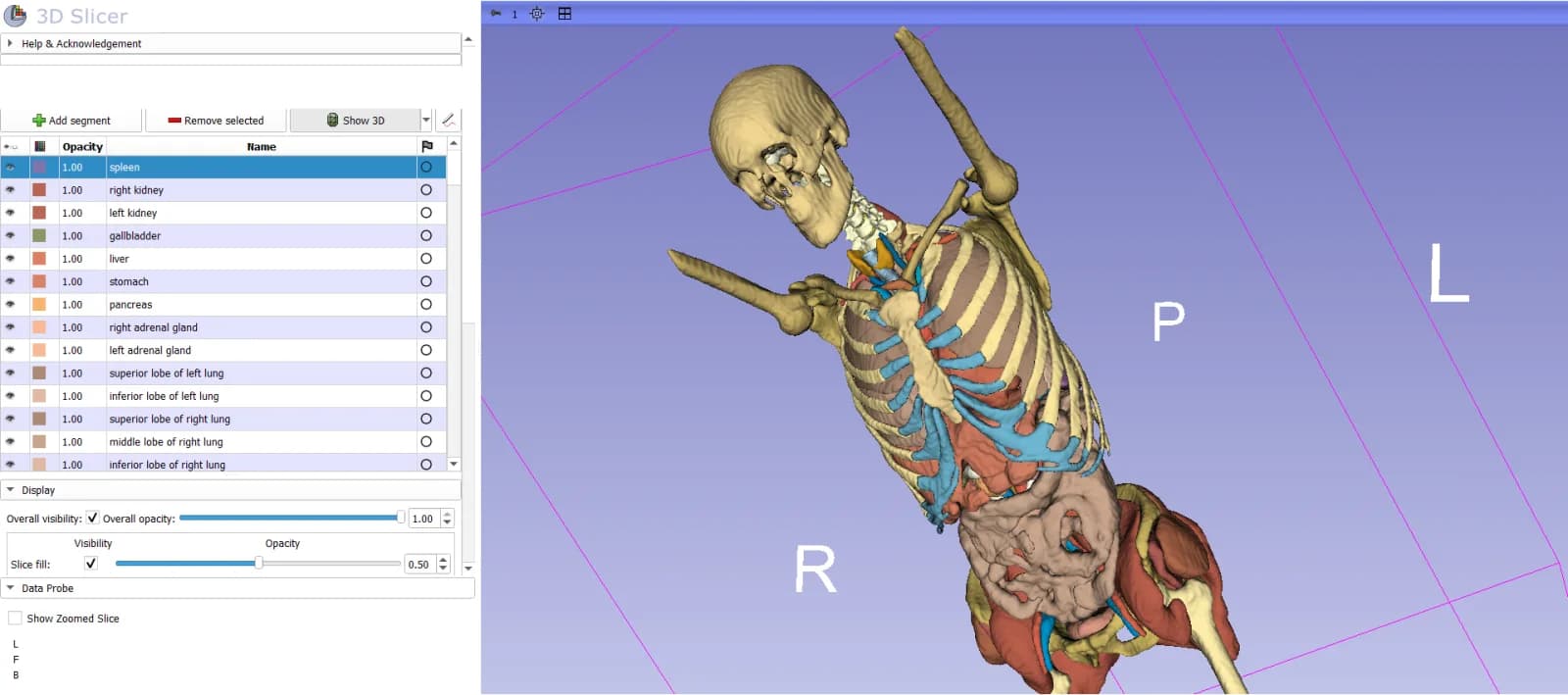 3D Slicer showing the list of segmented structures (spleen, kidneys, liver, lung lobes…) next to the 3D reconstruction of the skeleton and organs